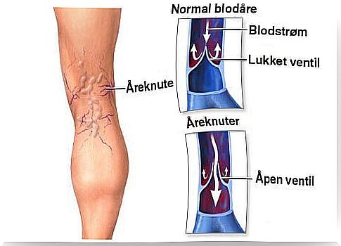 varicose veins