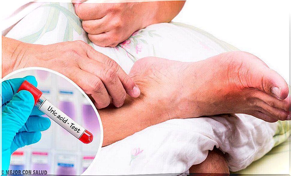 5 common causes of high levels of uric acid