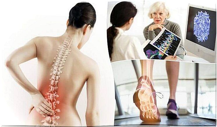 6 facts about osteoporosis you should know