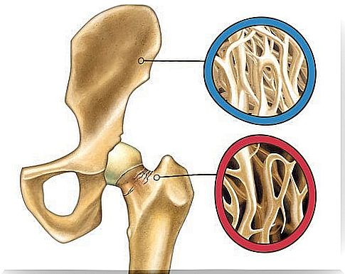 6 facts about osteoporosis you should know