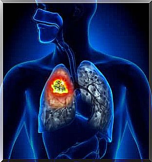 Different types of lung cancer