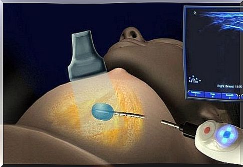 Cryoablation: A new treatment for breast cancer