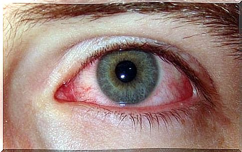 Dry eye syndrome