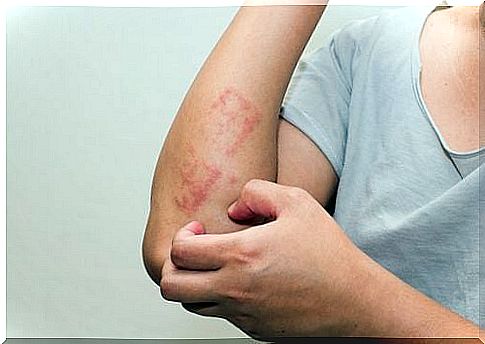 Five ways to keep psoriasis at bay