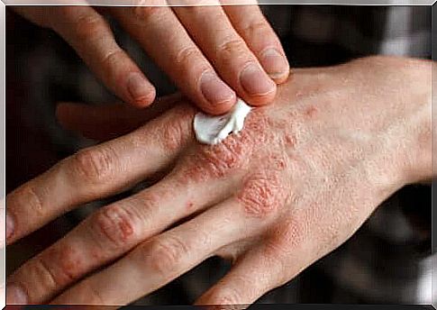 Psoriasis on hand