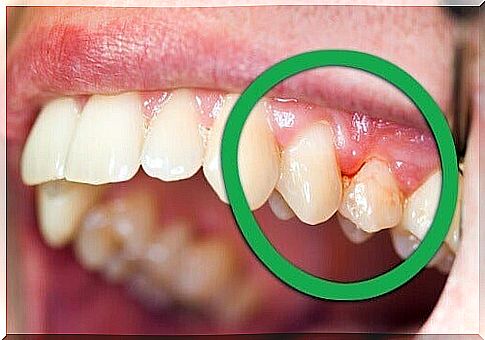 Natural ways to treat gingivitis