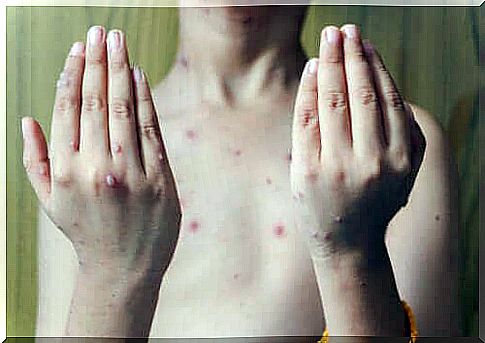 Symptoms and treatment of shingles in children