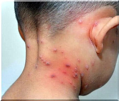 A child with herpes.