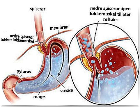 Tips to reduce acid reflux