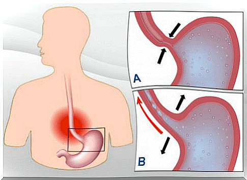 2-reflux