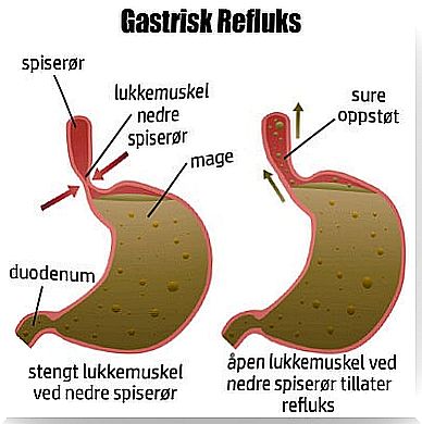 gastric reflux