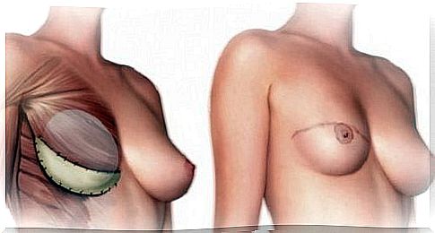 What should you know before a mastectomy?