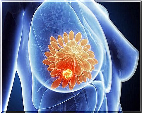 3-mastectomy diagram